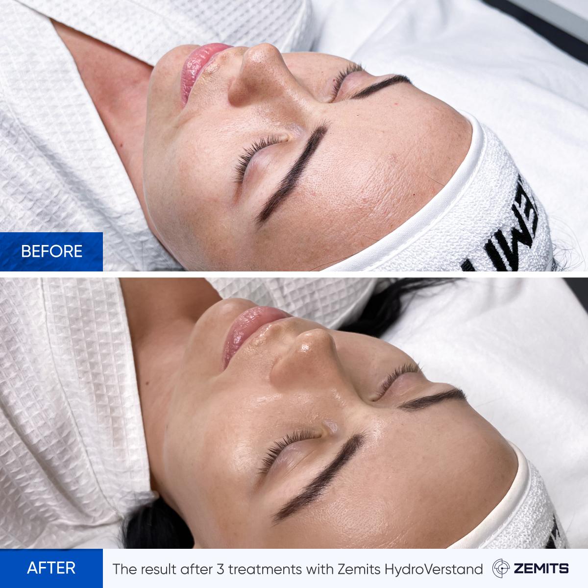 HydroVerstand Pro Facial before and after