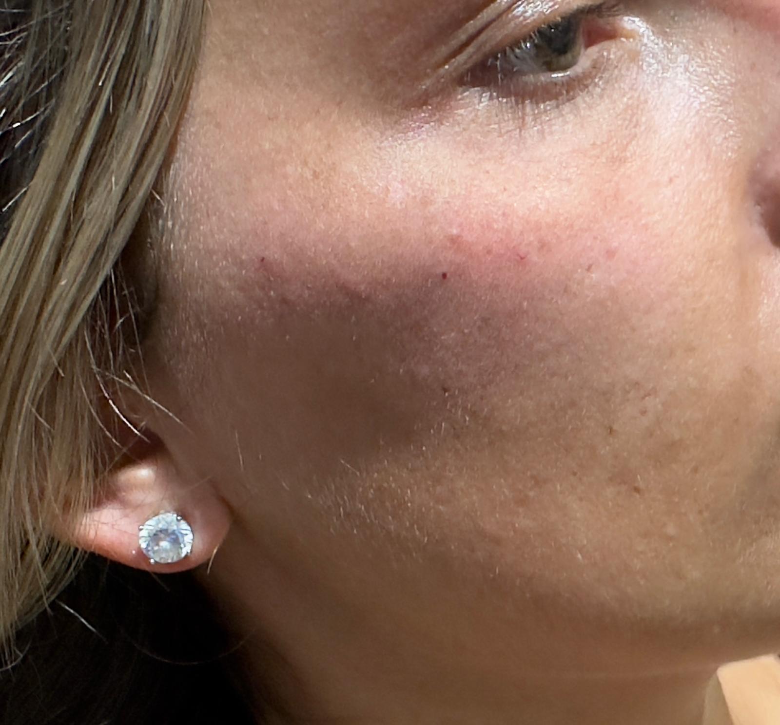 Cheek Filler after
