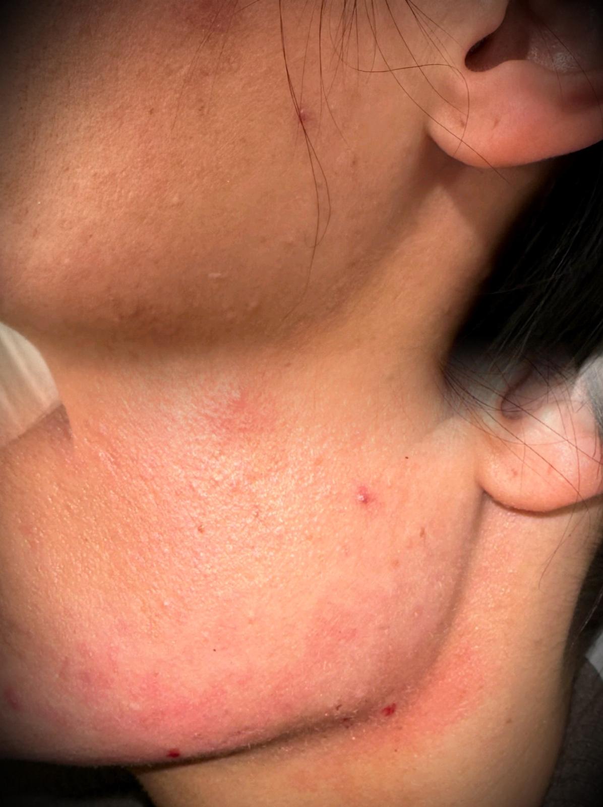 Jawline Filler before and after
