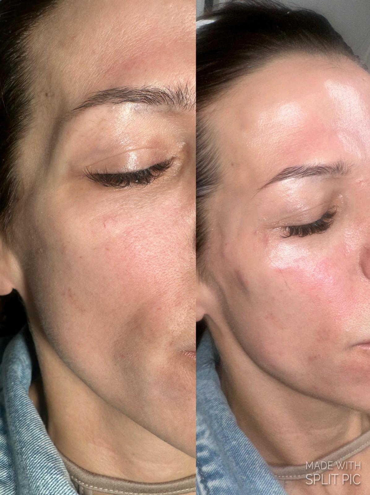 Temple Filler before and after