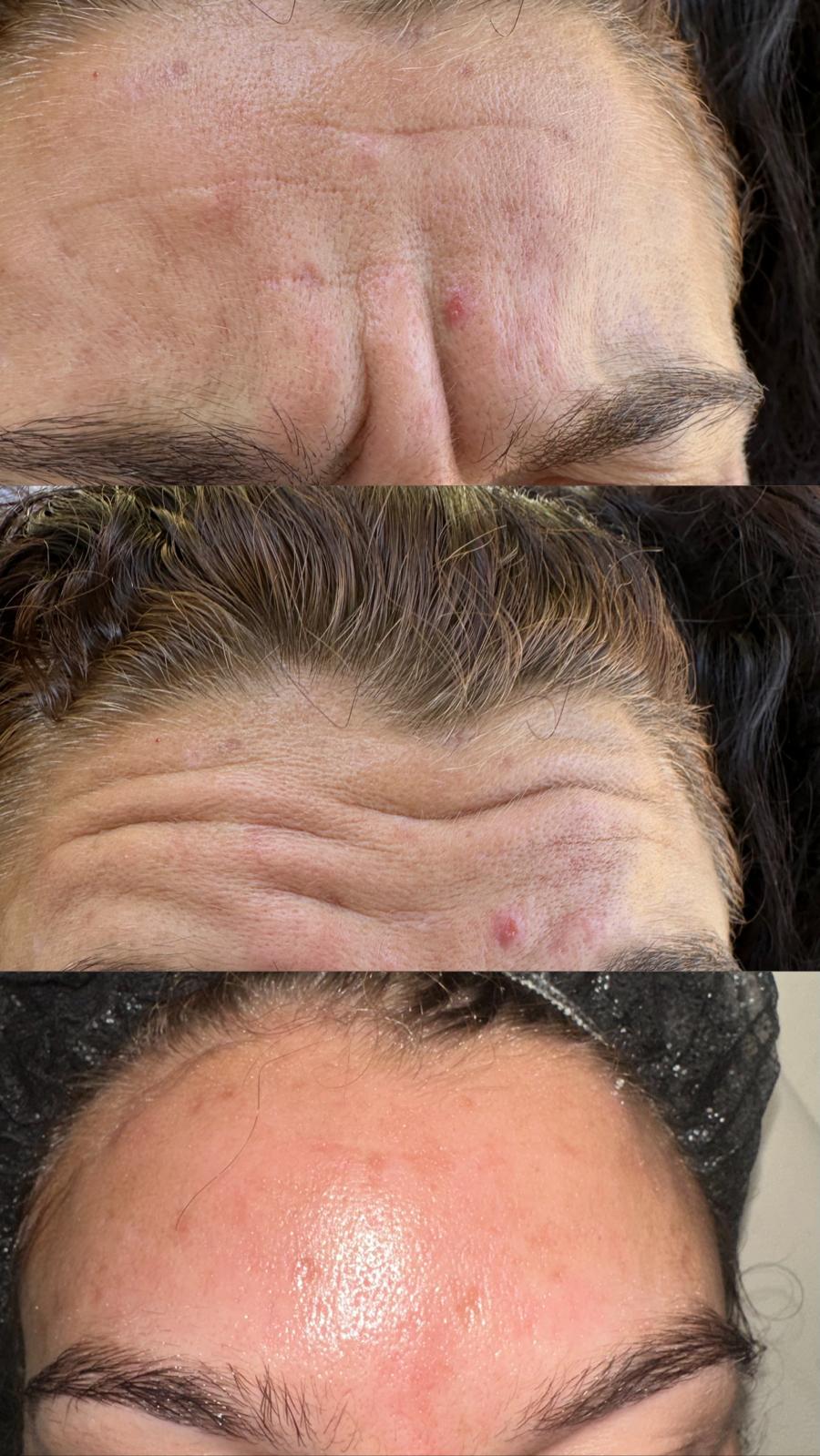 Anti-Wrinkle Treatment before and after