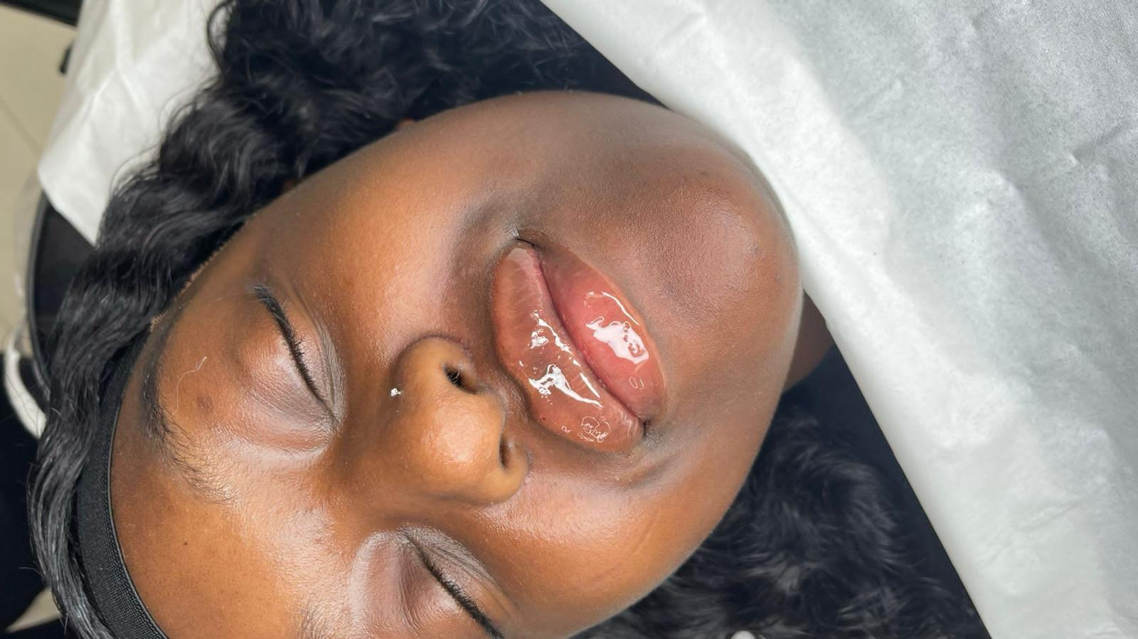 Lip filler treatment example