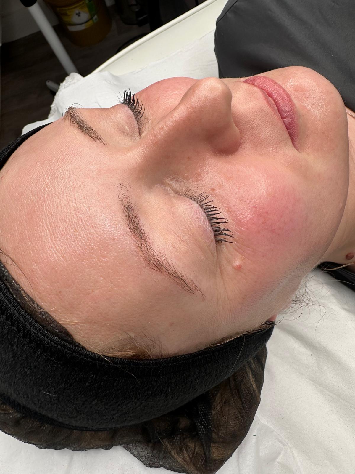 After HydraDiamond facial treatment