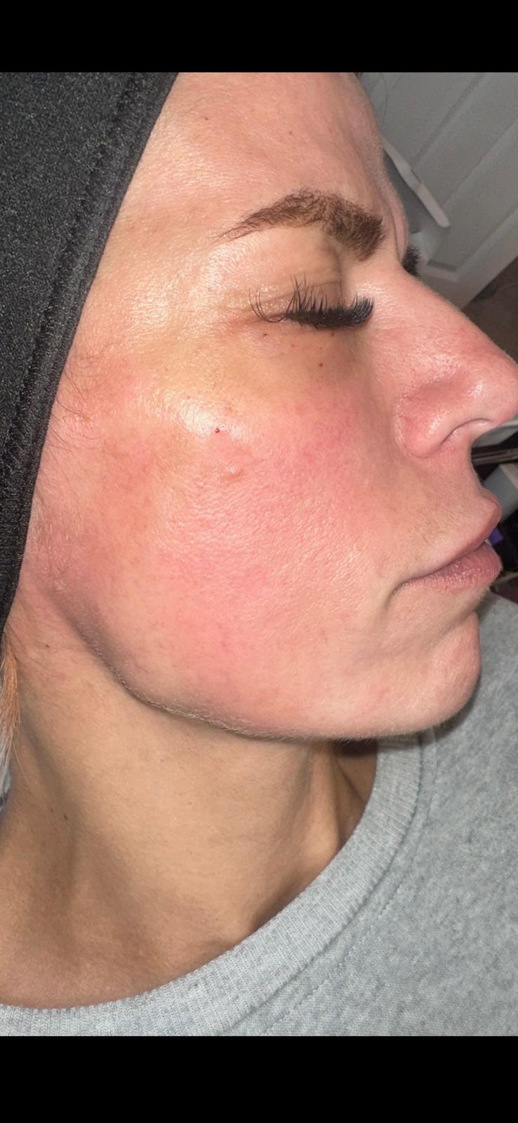 Liquid Facelift after