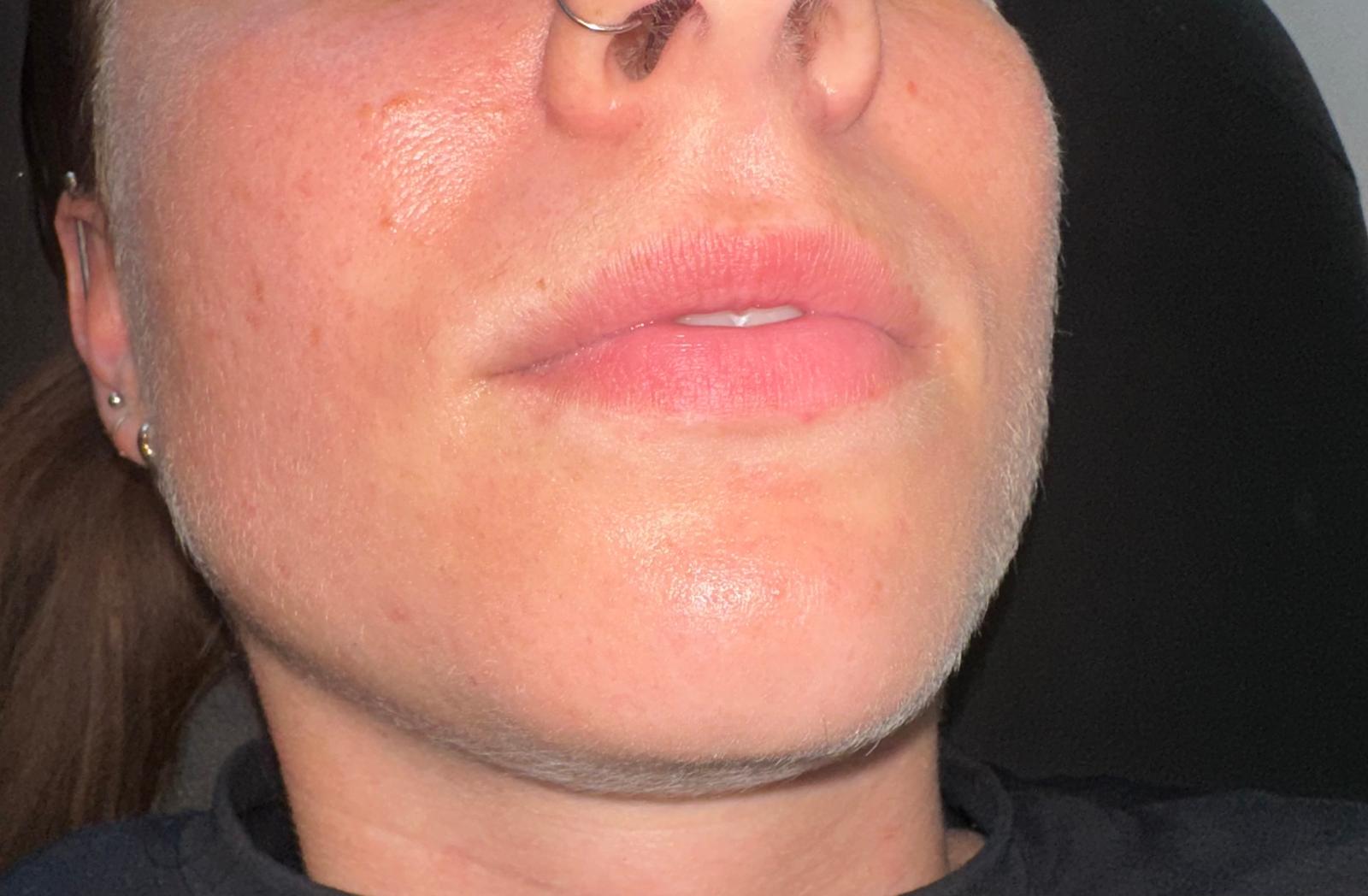 Lip Filler before