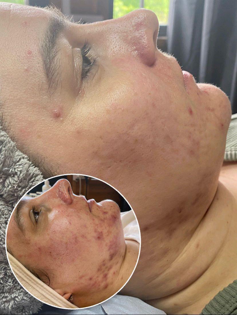 Acne management treatment result