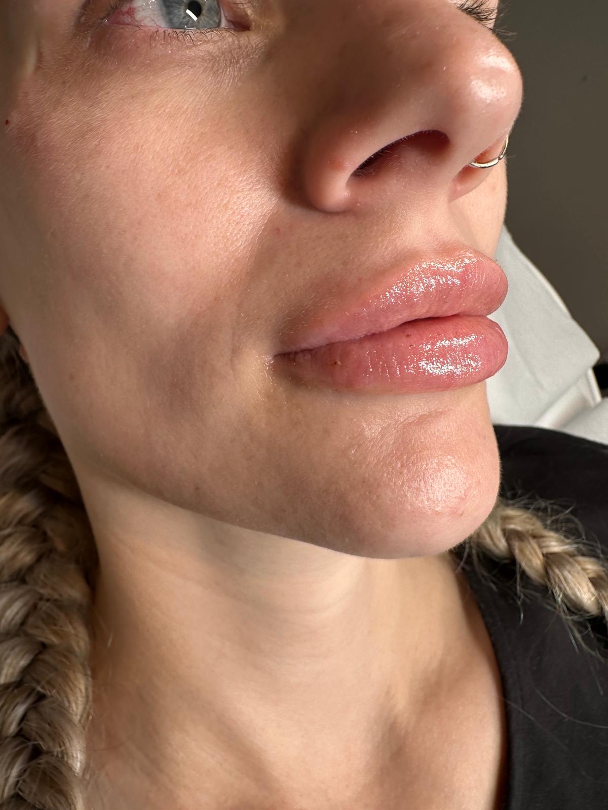 After lip filler treatment
