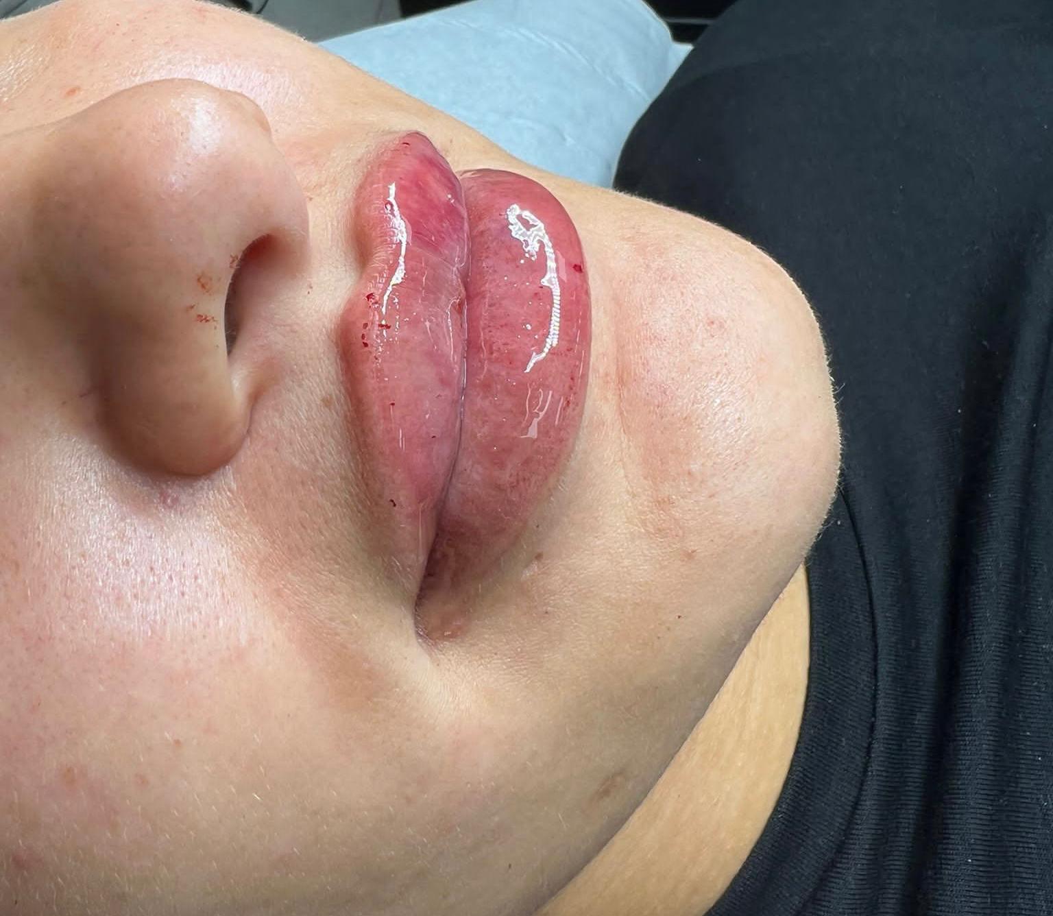 Lip filler treatment example