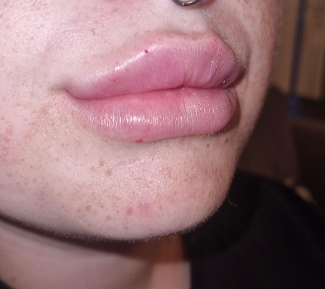 Lip Filler after