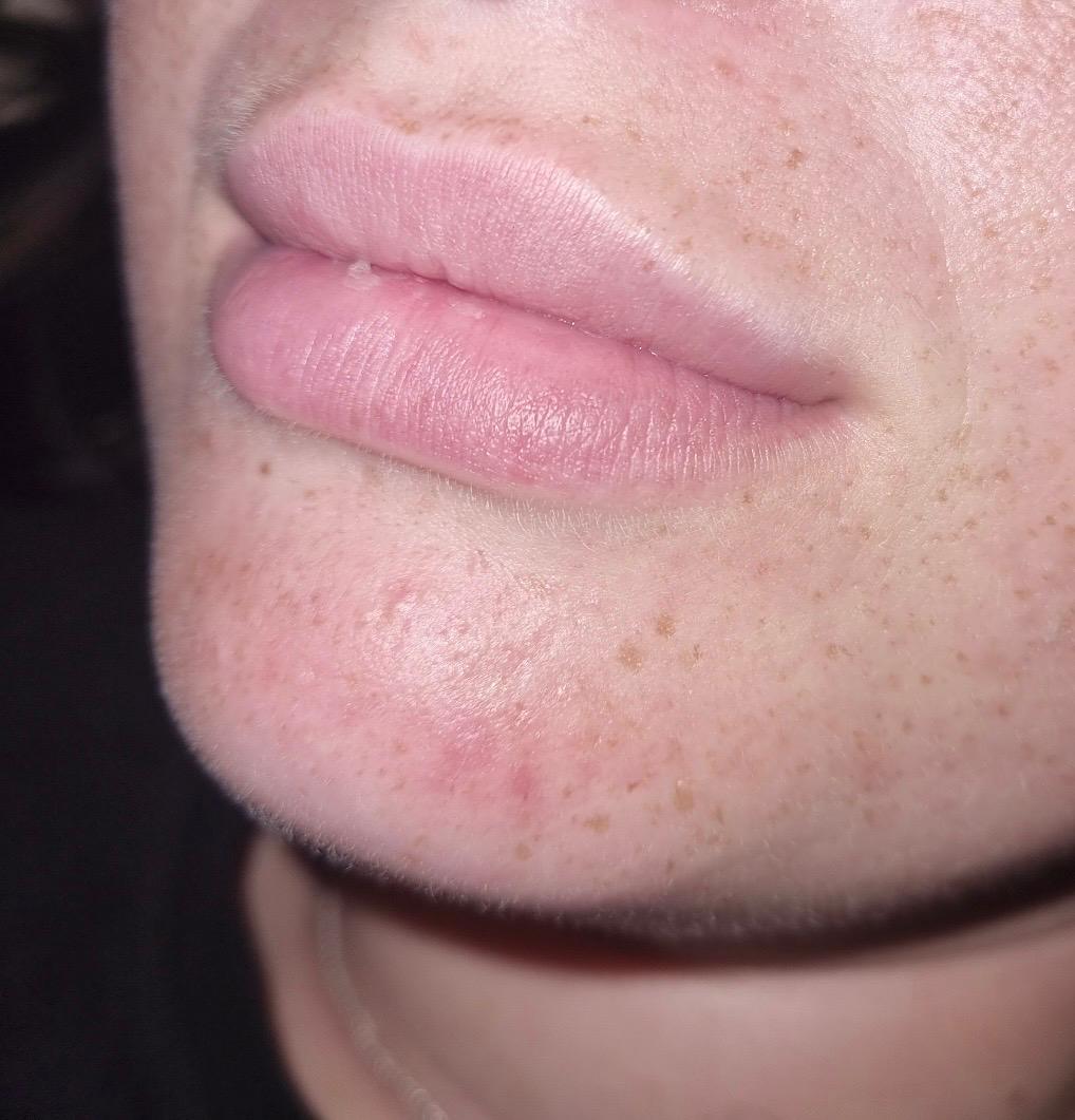 Lip Filler before
