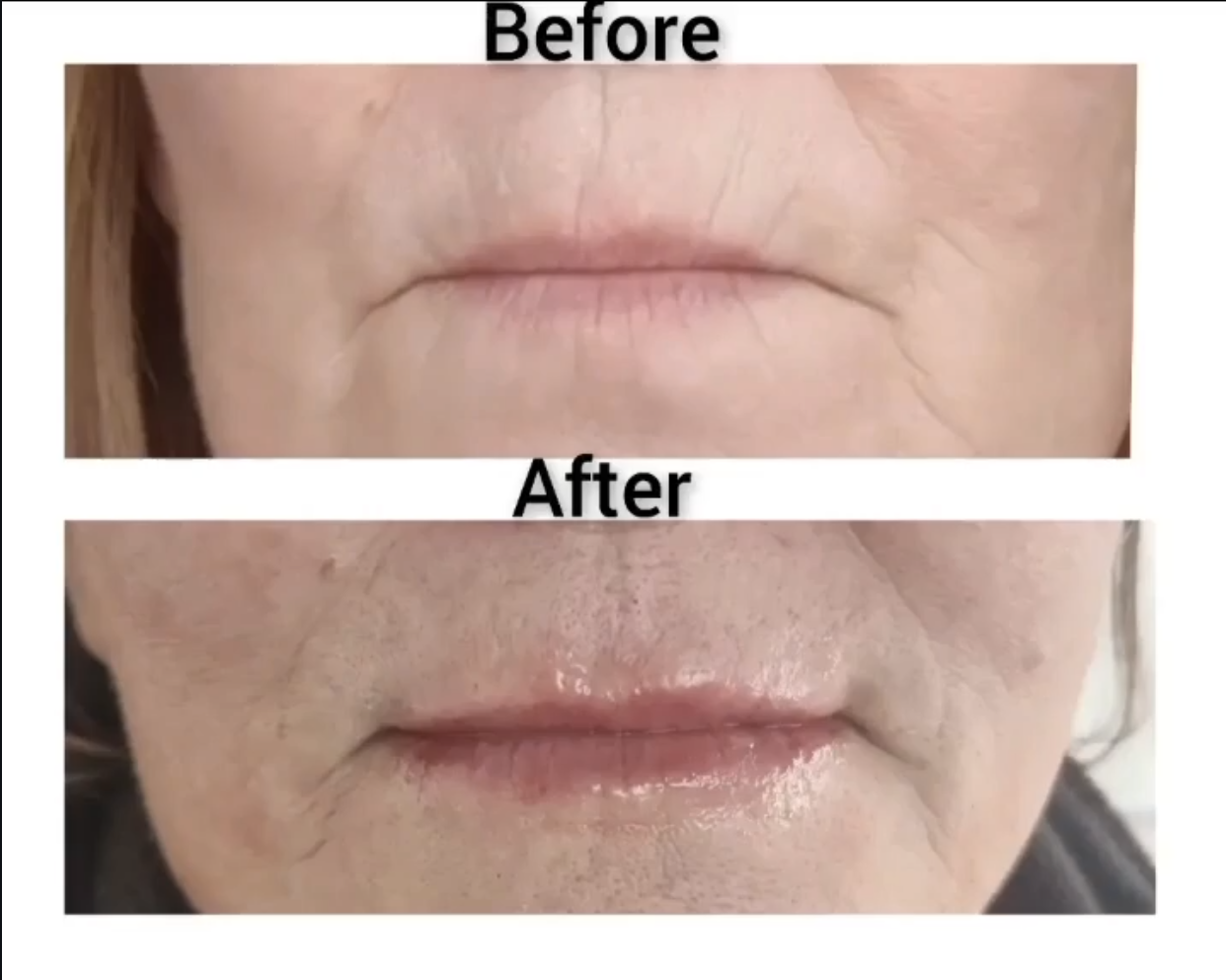 Smokers Lines before and after
