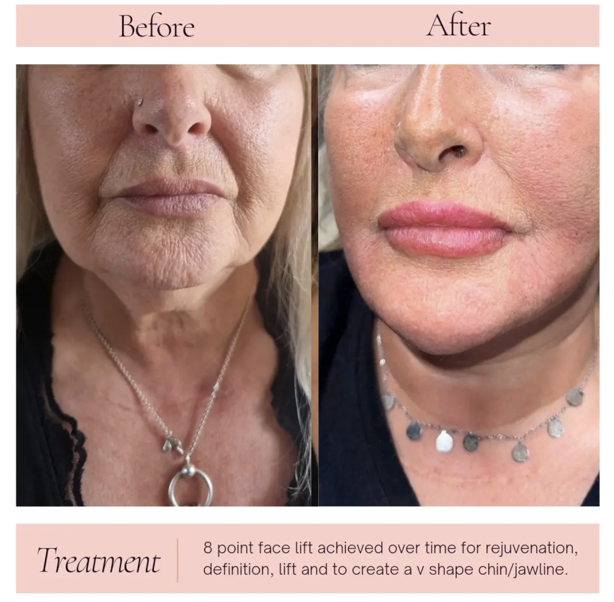 Dermal Fillers before and after