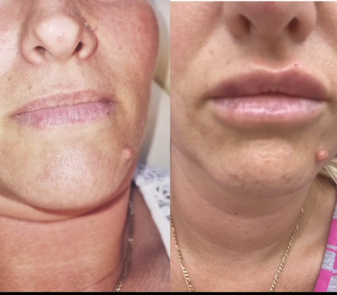 Lip Fillers before and after