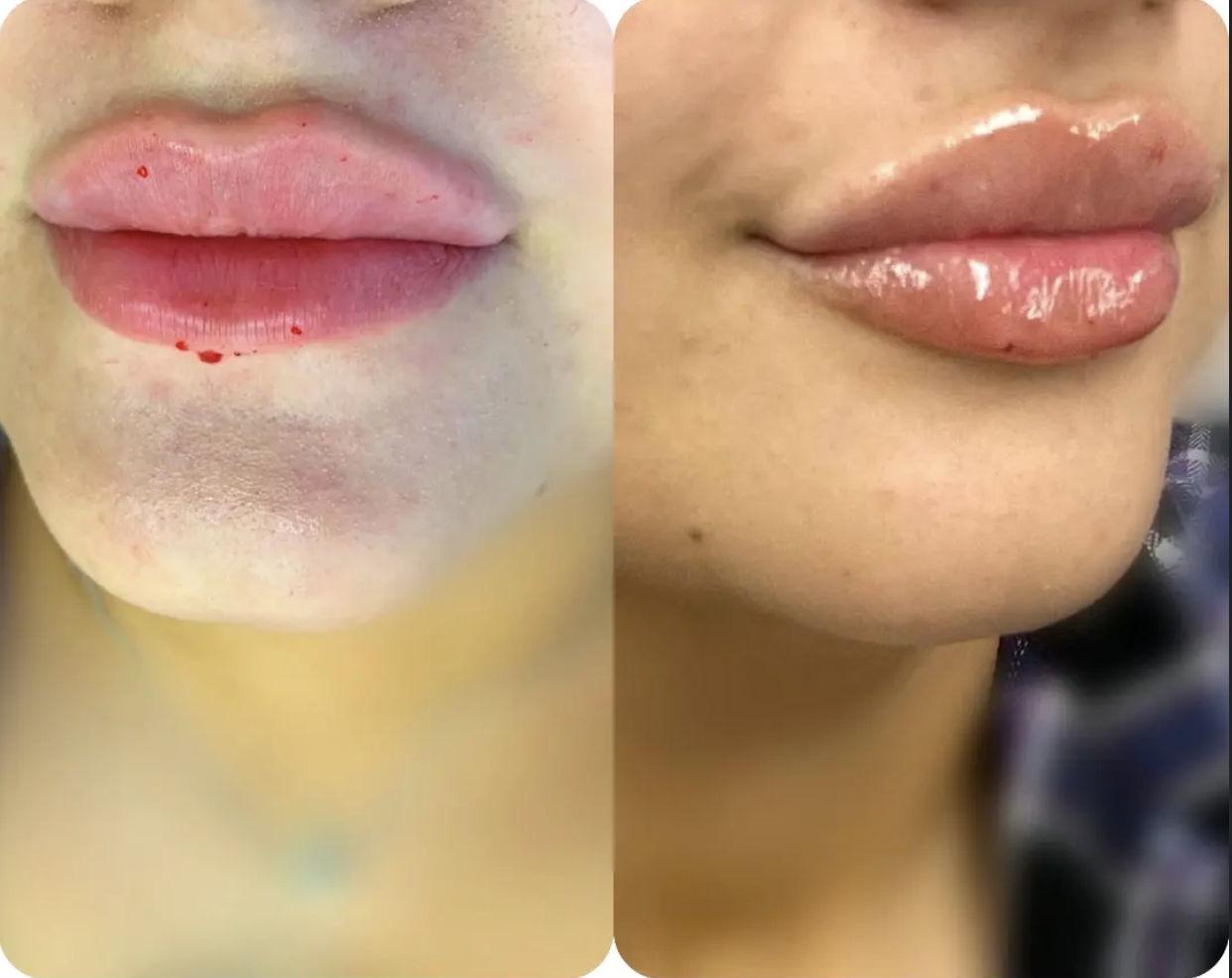 Lip Fillers before and after