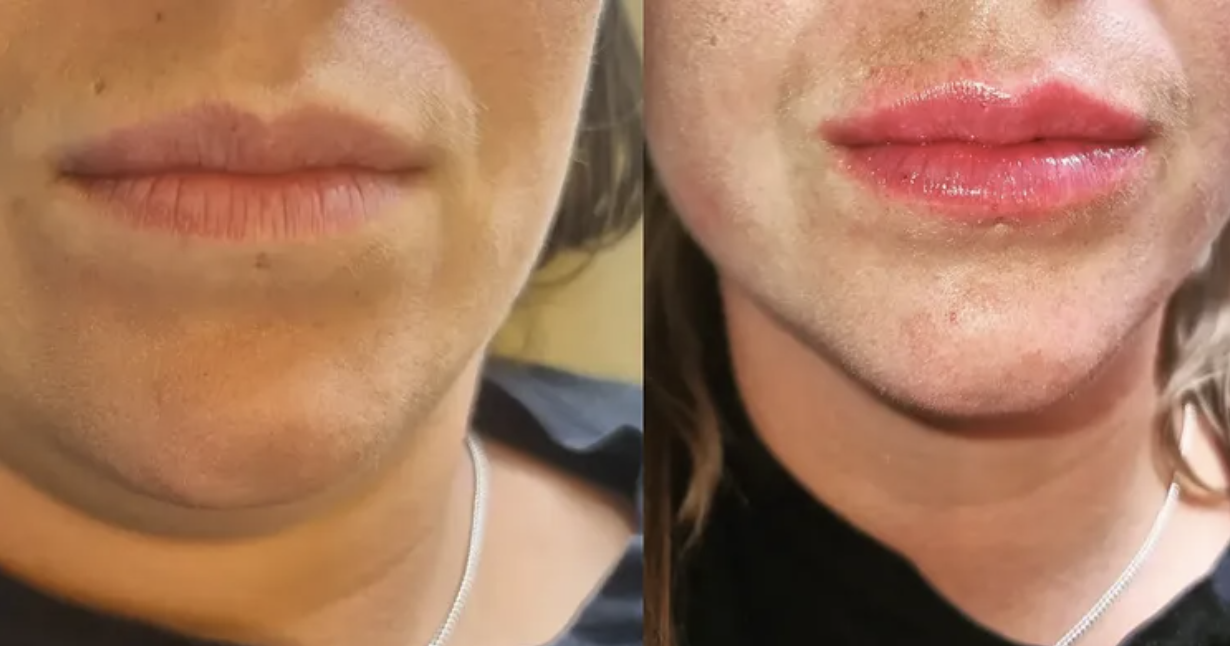 Lip Fillers before and after