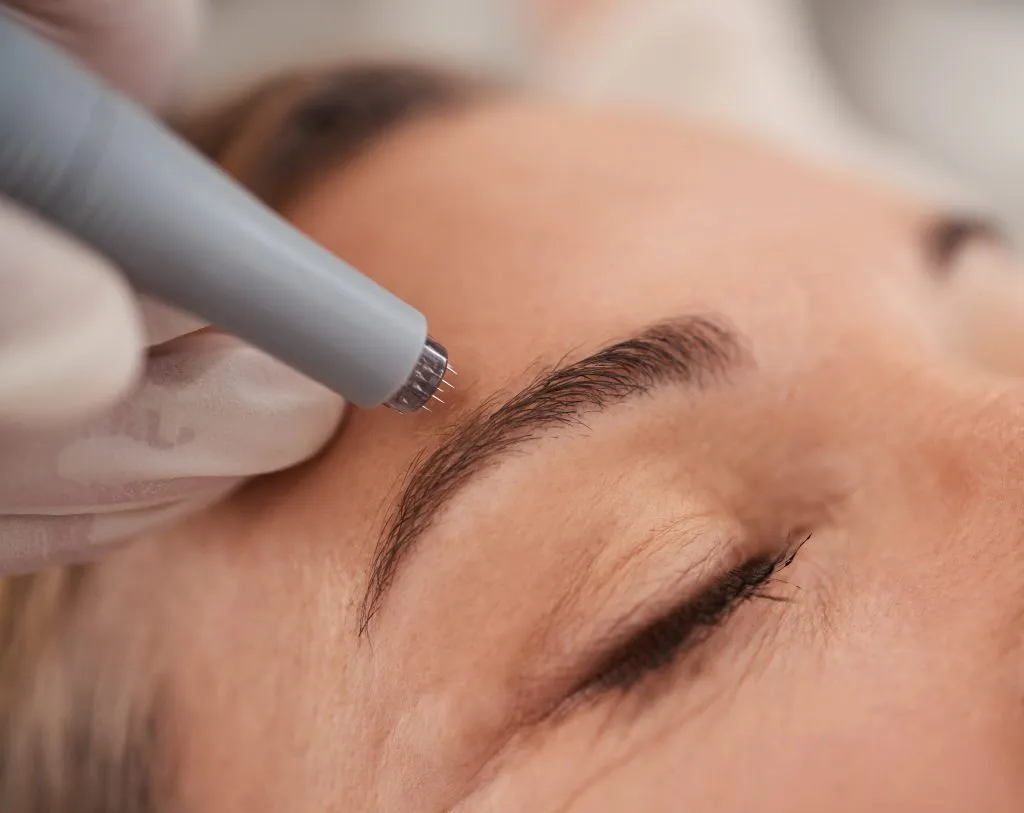 Microneedling